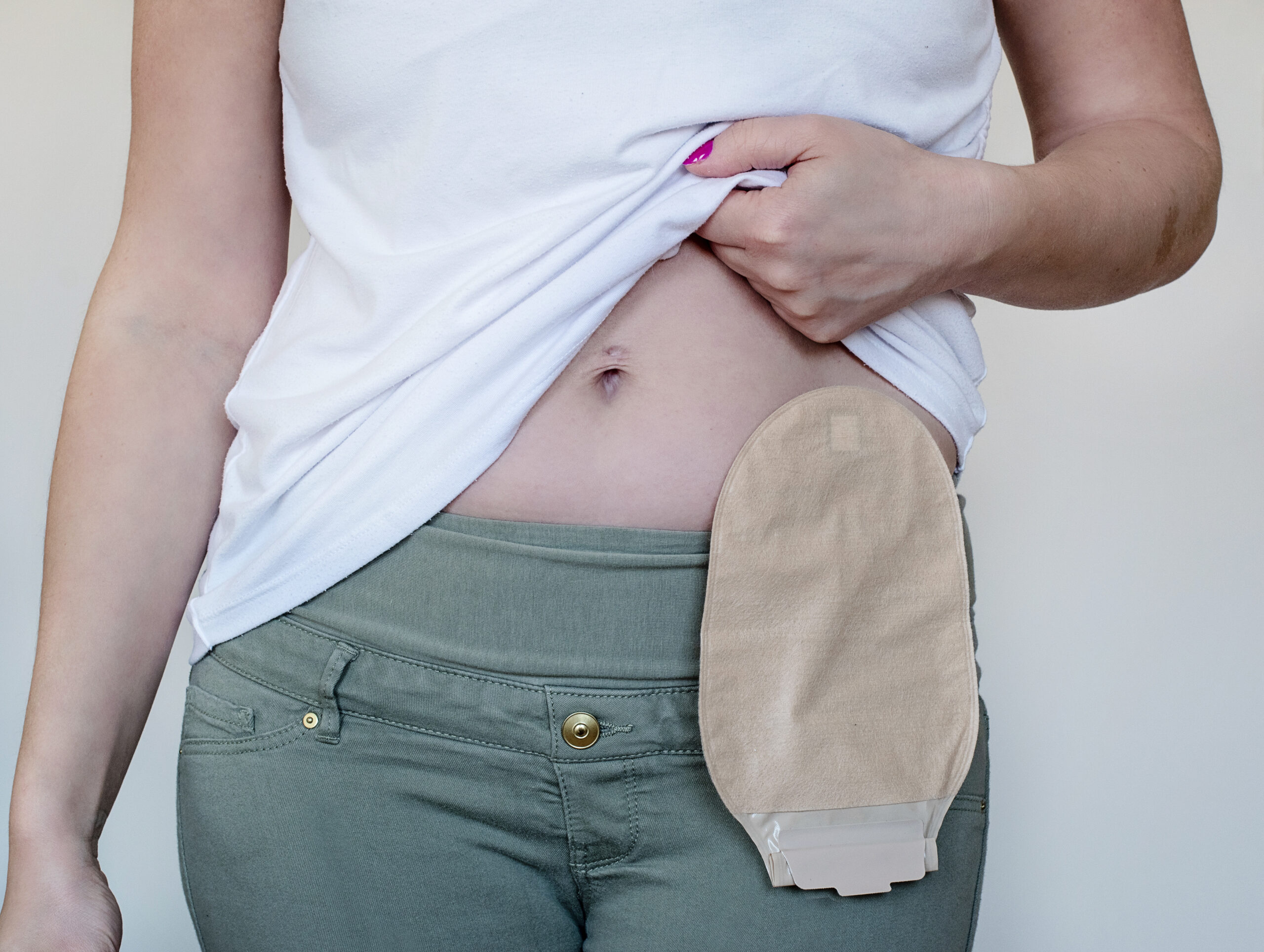 How To Prevent Pancaking In A Stoma Bag
