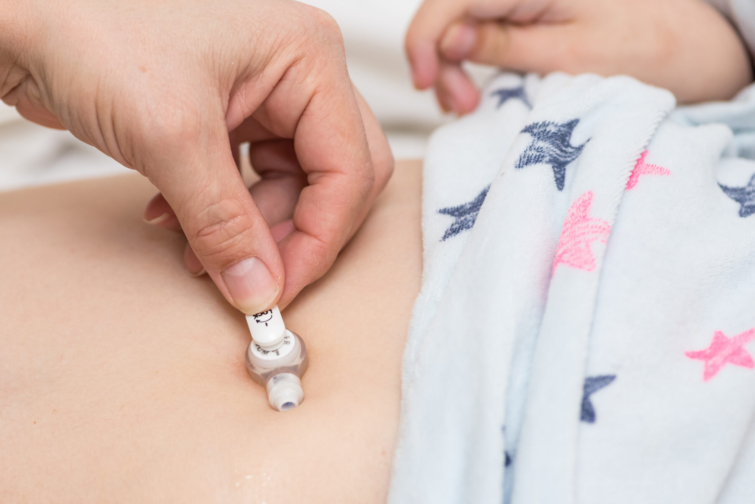 Troubleshooting site irritation and tube leakage on a feeding tube