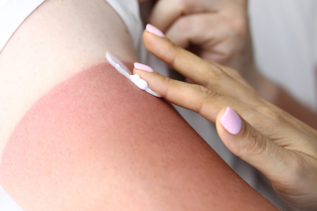 Lotion is applied to a first-degree burn